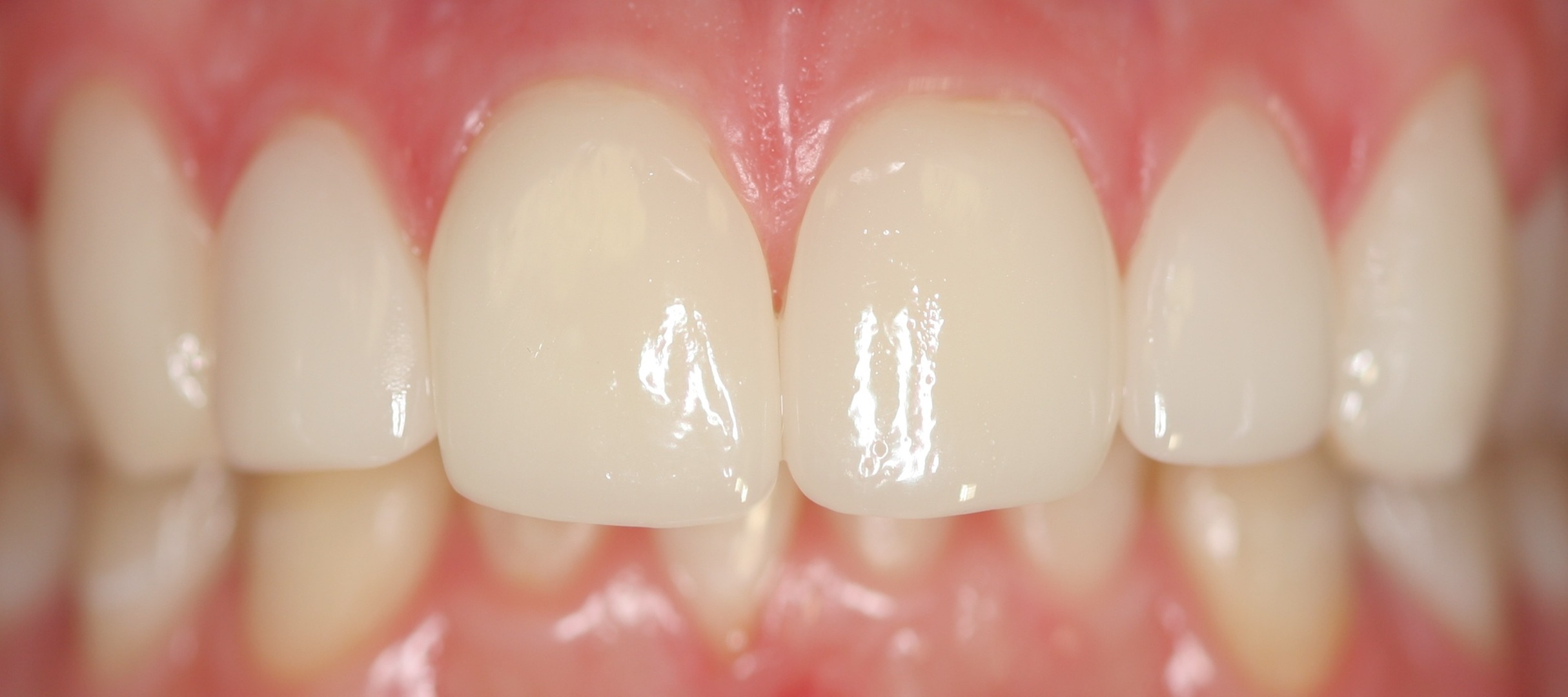 After – CEREC Same Day Restorations