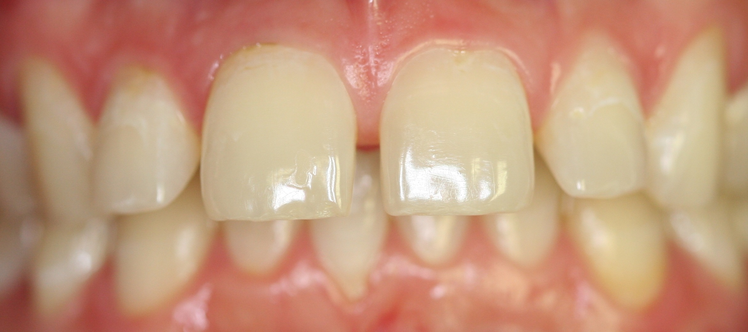 Before – CEREC Same Day Restorations