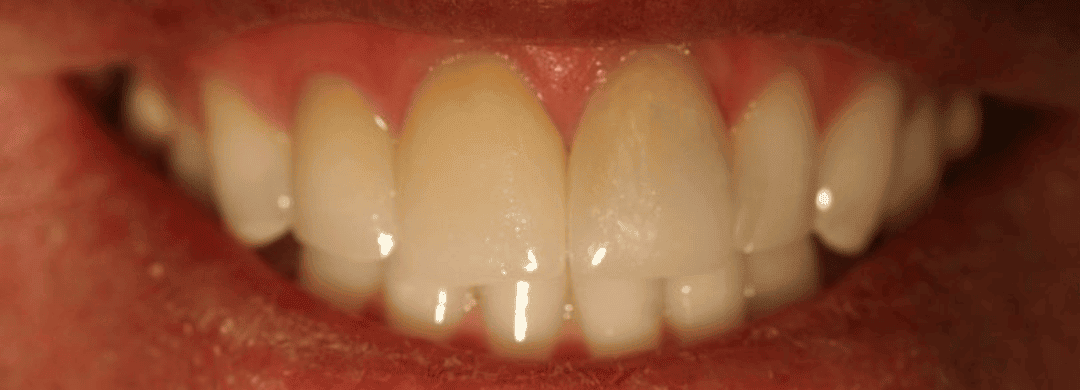 After – Cosmetic Dentistry