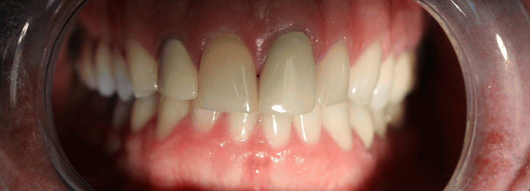Before – Cosmetic Dentistry