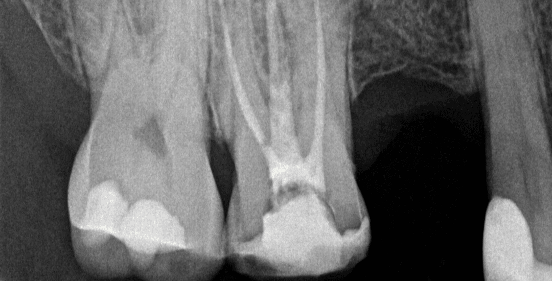 After – Endodontics: Root Canal Therapy