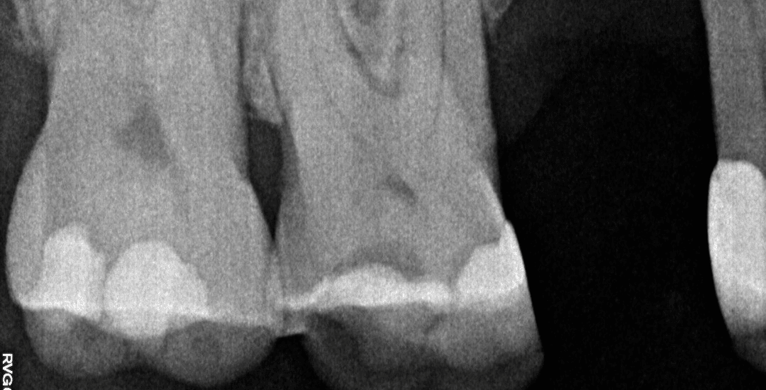 Before – Endodontics: Root Canal Therapy