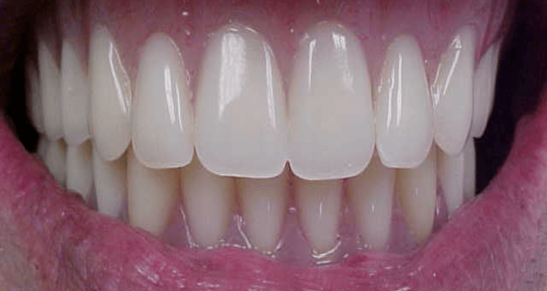 After – Full Mouth Rehabilitations