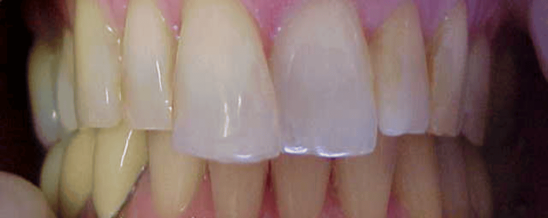 After – Full Mouth Rehabilitations