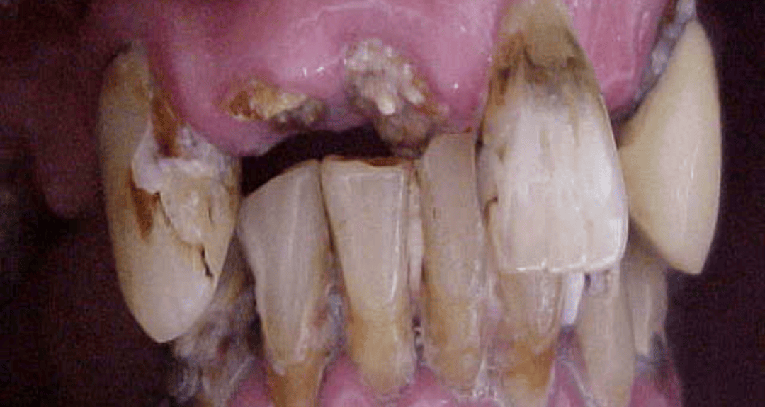 Before – Full Mouth Rehabilitations