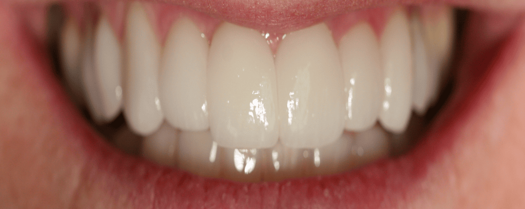 Before – Full Mouth Rehabilitations