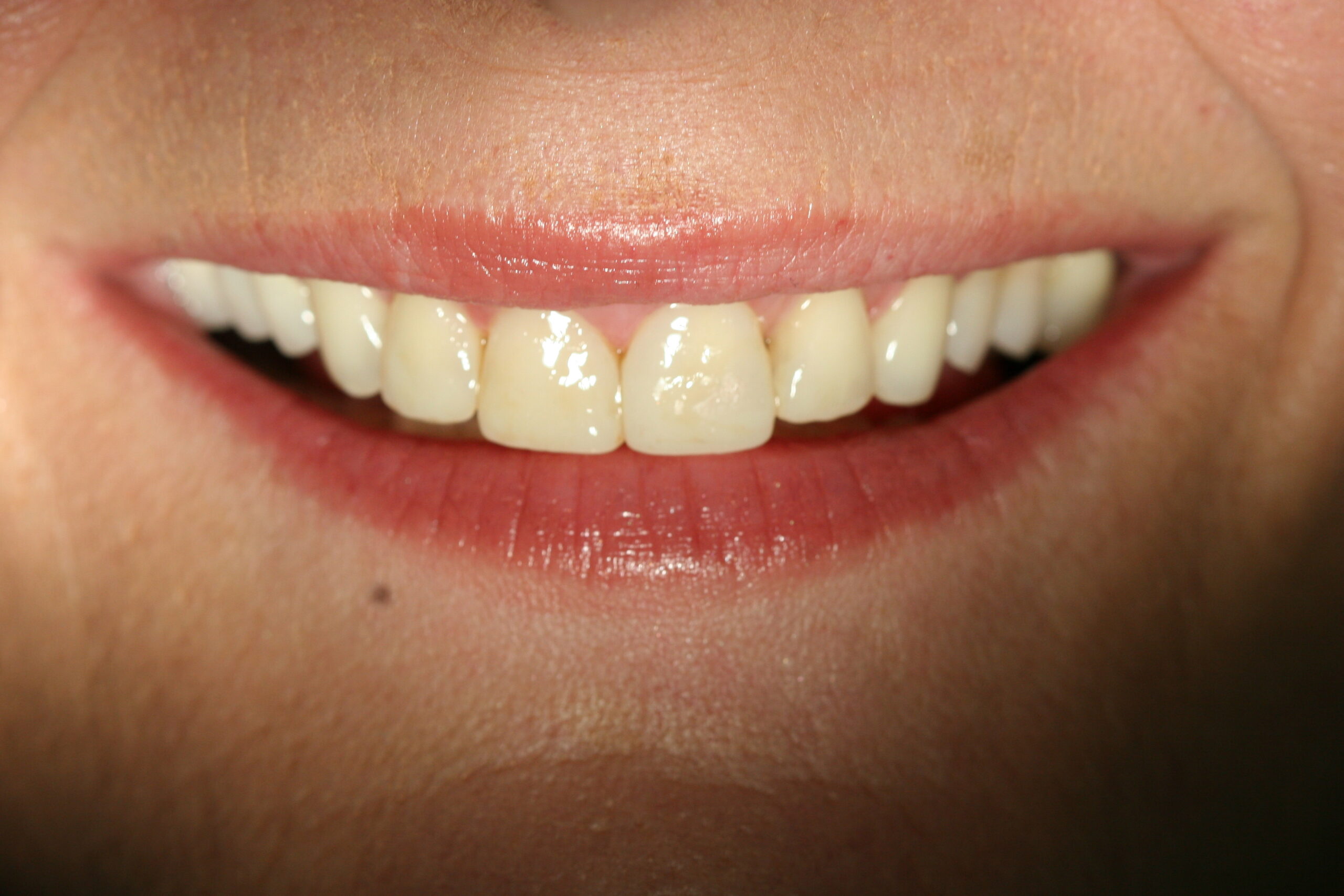 Before – Full Mouth Rehabilitations