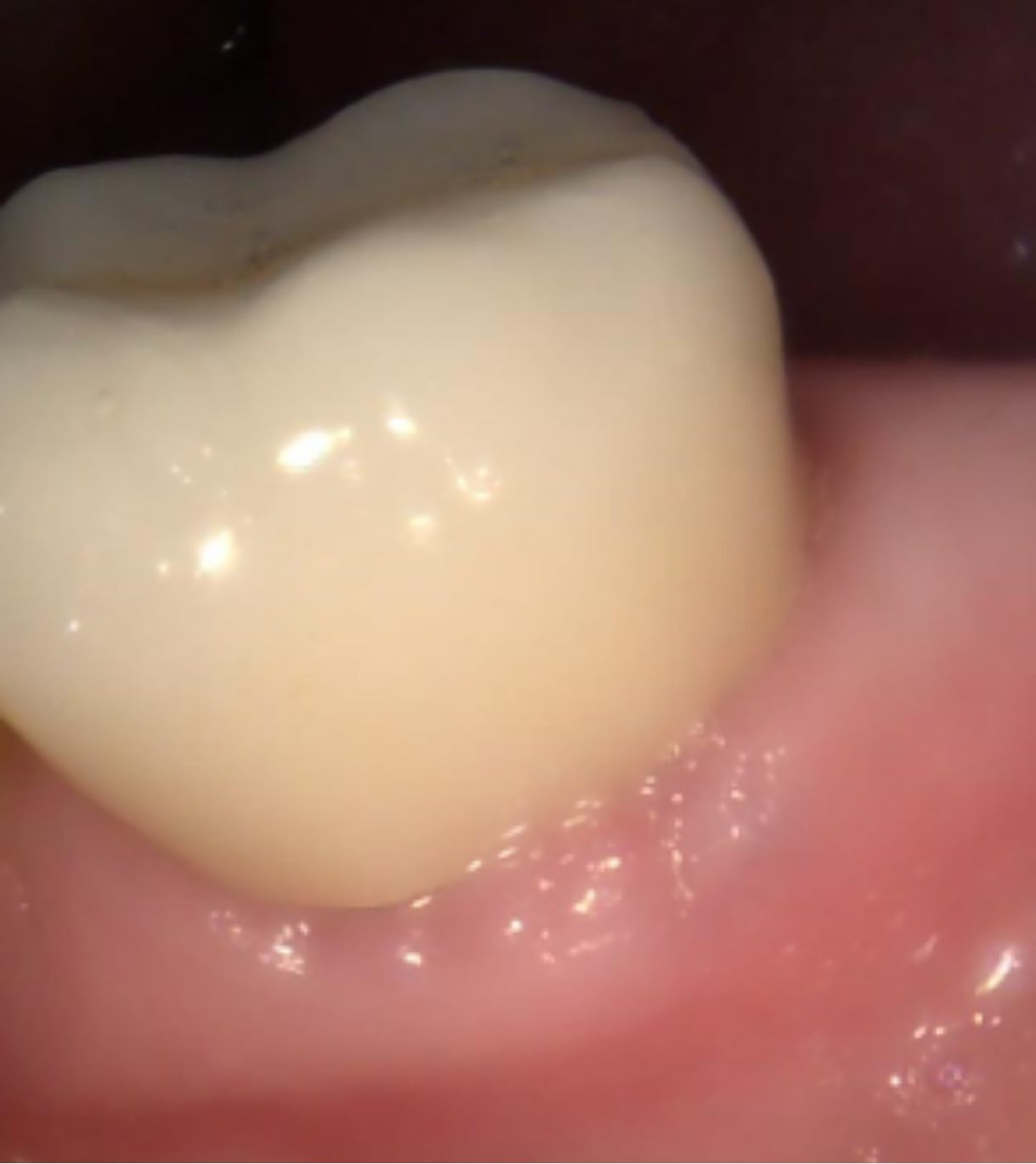 After – Laser Dentistry