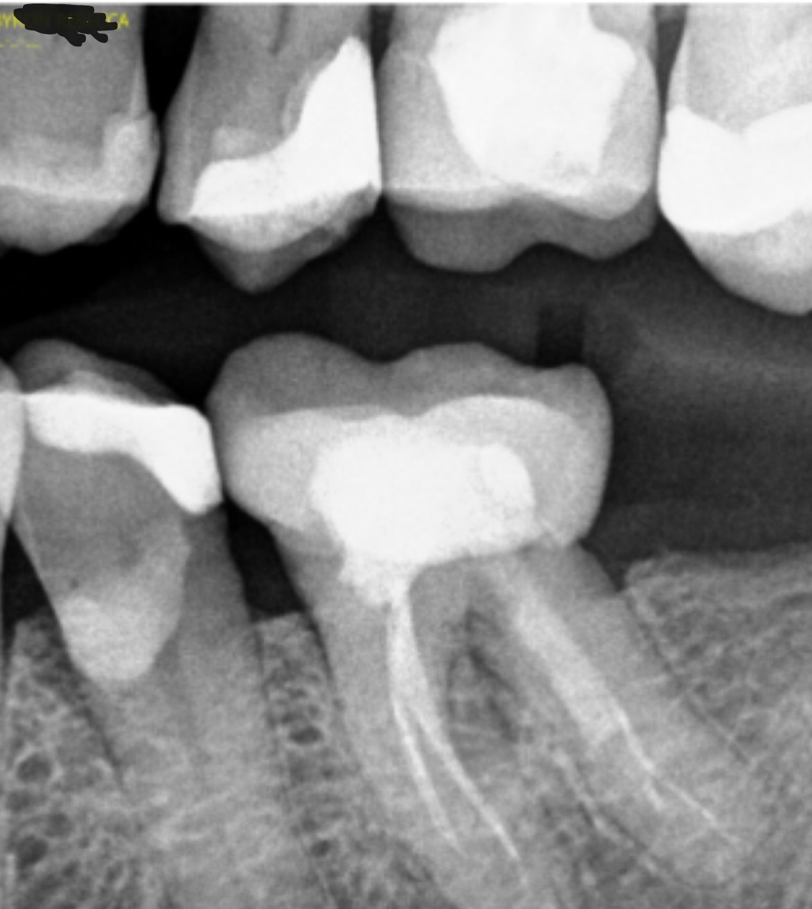 After – Laser Dentistry