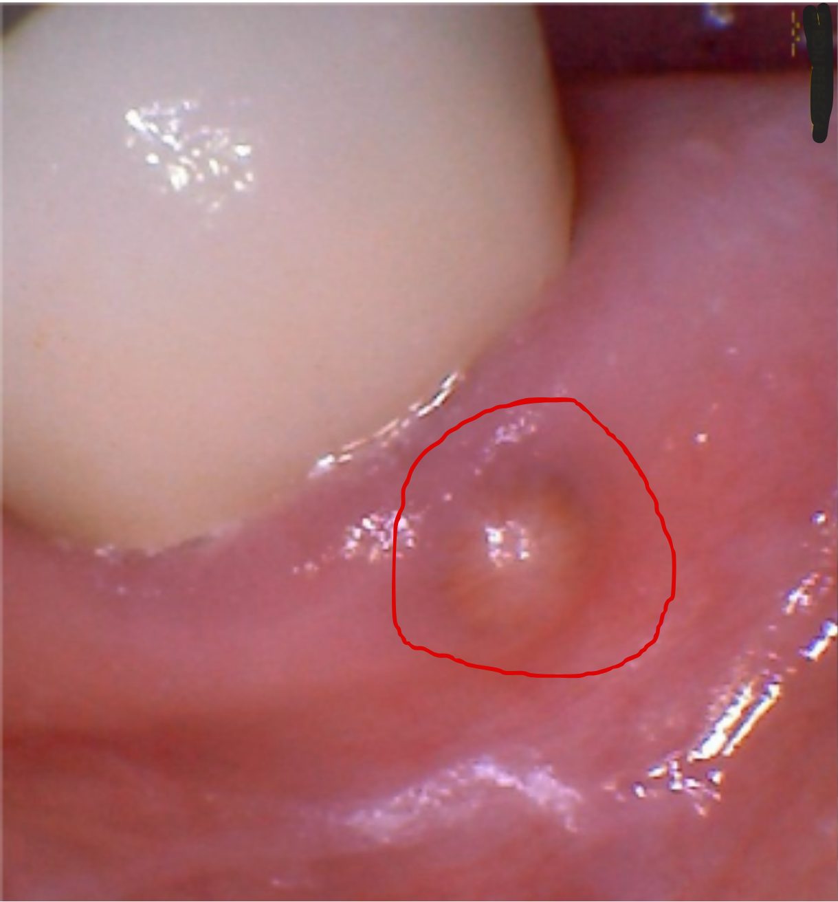 Before – Laser Dentistry