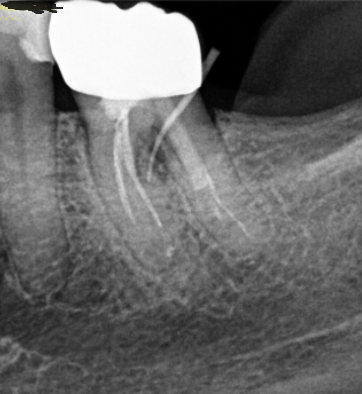 Before – Laser Dentistry