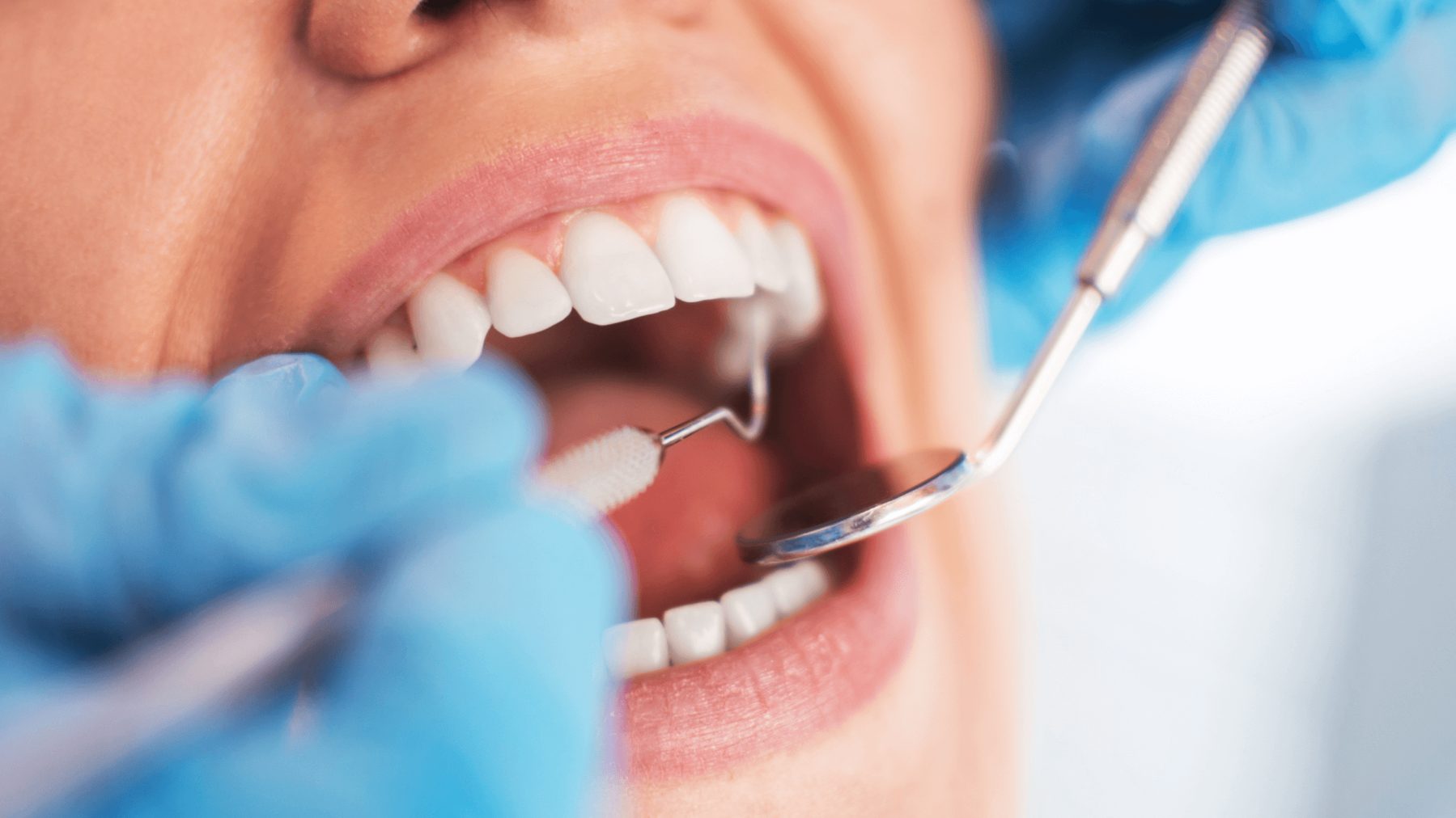 What is a T-Scan Bite Analysis?