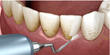 dental cleaning