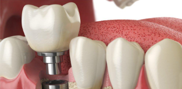 dental implants